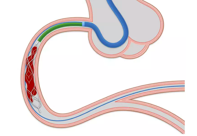 DFCapodanno's tweet photo. This mechanical thrombectomy device, called NeVa, has been designed to improve the incorporation and removal of large, organised thrombi. Here are the results of its first-in-human prospective study in patients with acute coronary syndromes. https://t.co/pGzvMwFE2t https://t.co/ghpYdyzNTt