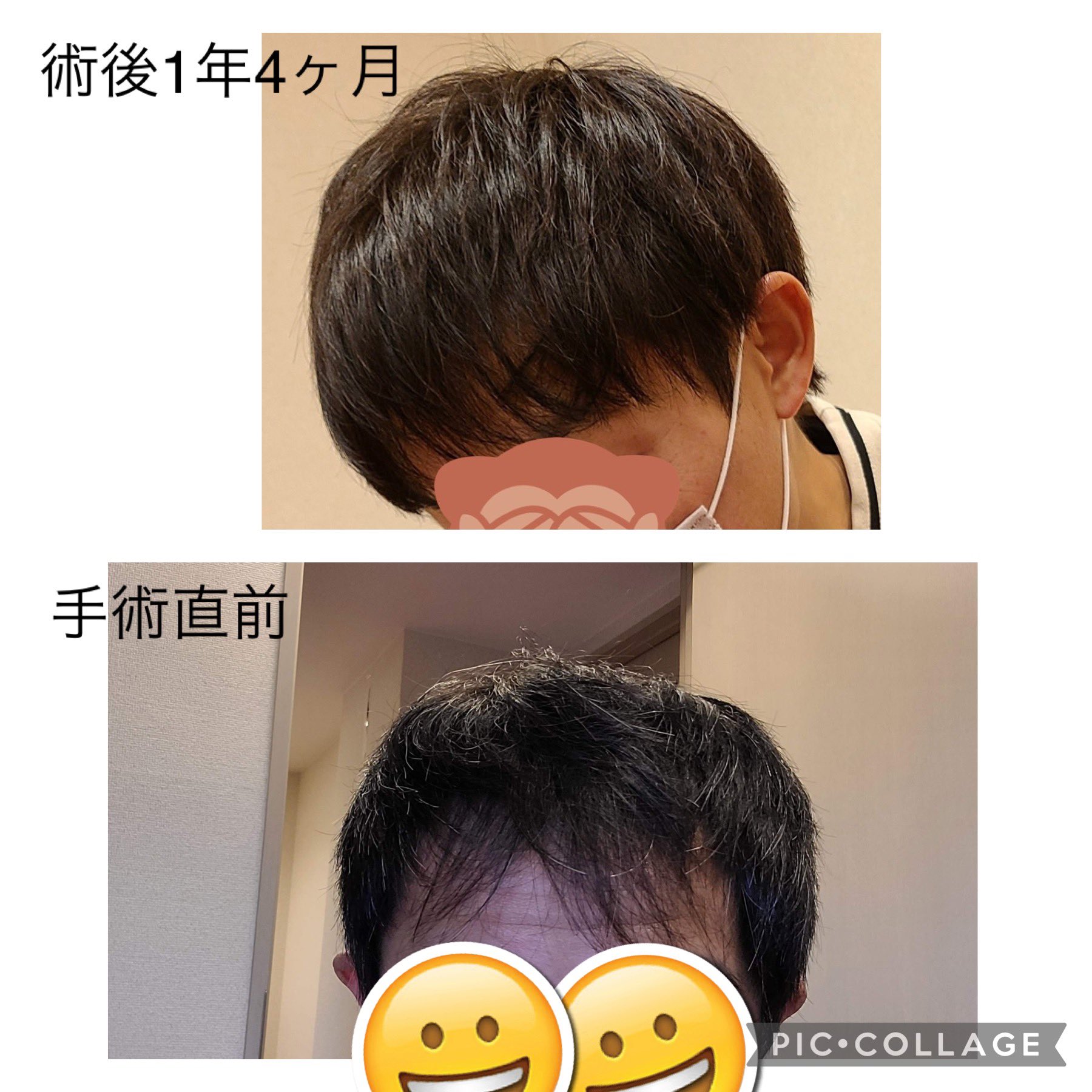 植毛 Fut 1511株 男 36歳 O7sgdnq05qa5qqb Twitter