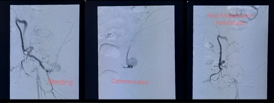 Embolotherapy for internal bleeding. 

Superior gluteal artery bleeding in young female evidenced by pseudoaneurysm, which was selectively catheterised and embolised with glue with instant hemostasis. 
#interventionalradiology
#embolotherapy