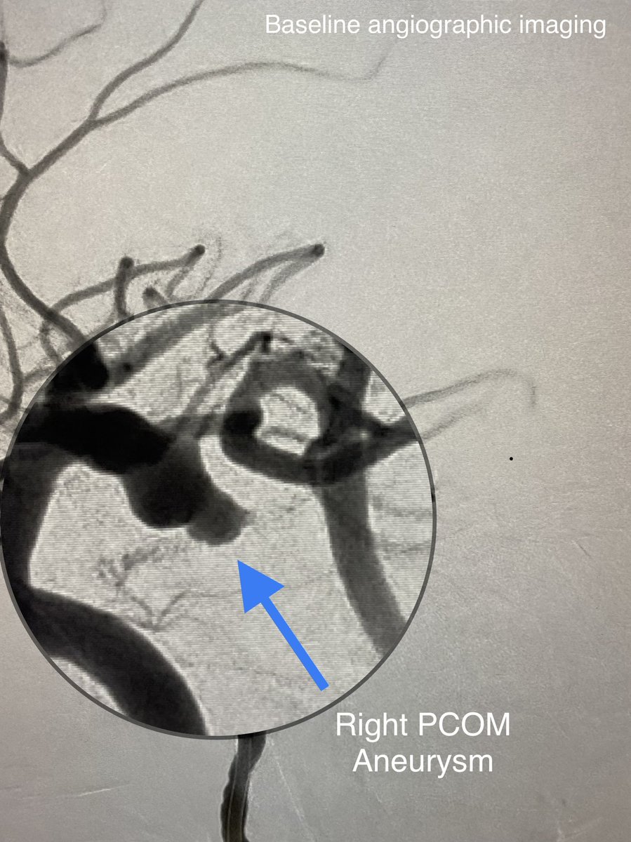 VascNeuro's tweet photo. 63F found w/ a nontraumatic intracranial hemorrhage required coil embolization of right posterior communicating artery aneurysm. Aneurysm measured 9mm x 5mm w/ 5mm neck. #neuroscience #neurology #neurotwitter #brain https://t.co/nJEEotrlgs