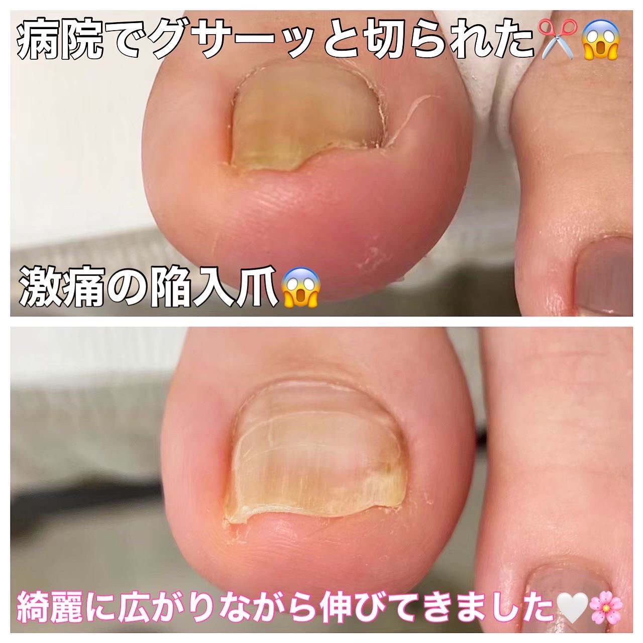 巻き爪サロン Libre 整形外科で変に切られた陥入爪 治療が死ぬほど痛かった 切り残しが刺さってもっと痛くなった とのことでご来店 激痛 パンッパンに腫れた状態でしたが 1ヶ月半で普通の爪に戻りました 南海高野線 堺東駅より徒歩1分 巻き