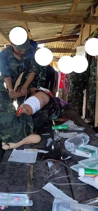2 KNDF comrades were hit by artillery shells while transporting patients during clashes with the SAC in Loikaw Tsp, Kayah State on Jan7. They are in critical condition &amp; require medical attention.
#ShamelessHunSen
#2022Jan8Coup
#WhatsHappeningInMyanmar