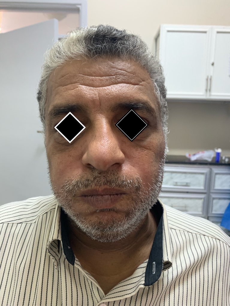 Cases101LY's tweet photo. Male Libyan patient presented with a swelling on the left side of the face suggestive of a parotid mass...
Review the full case by Dr. @MuftahBoughrara now on our website: https://t.co/E39IHl6JkW https://t.co/rqziys4pPm