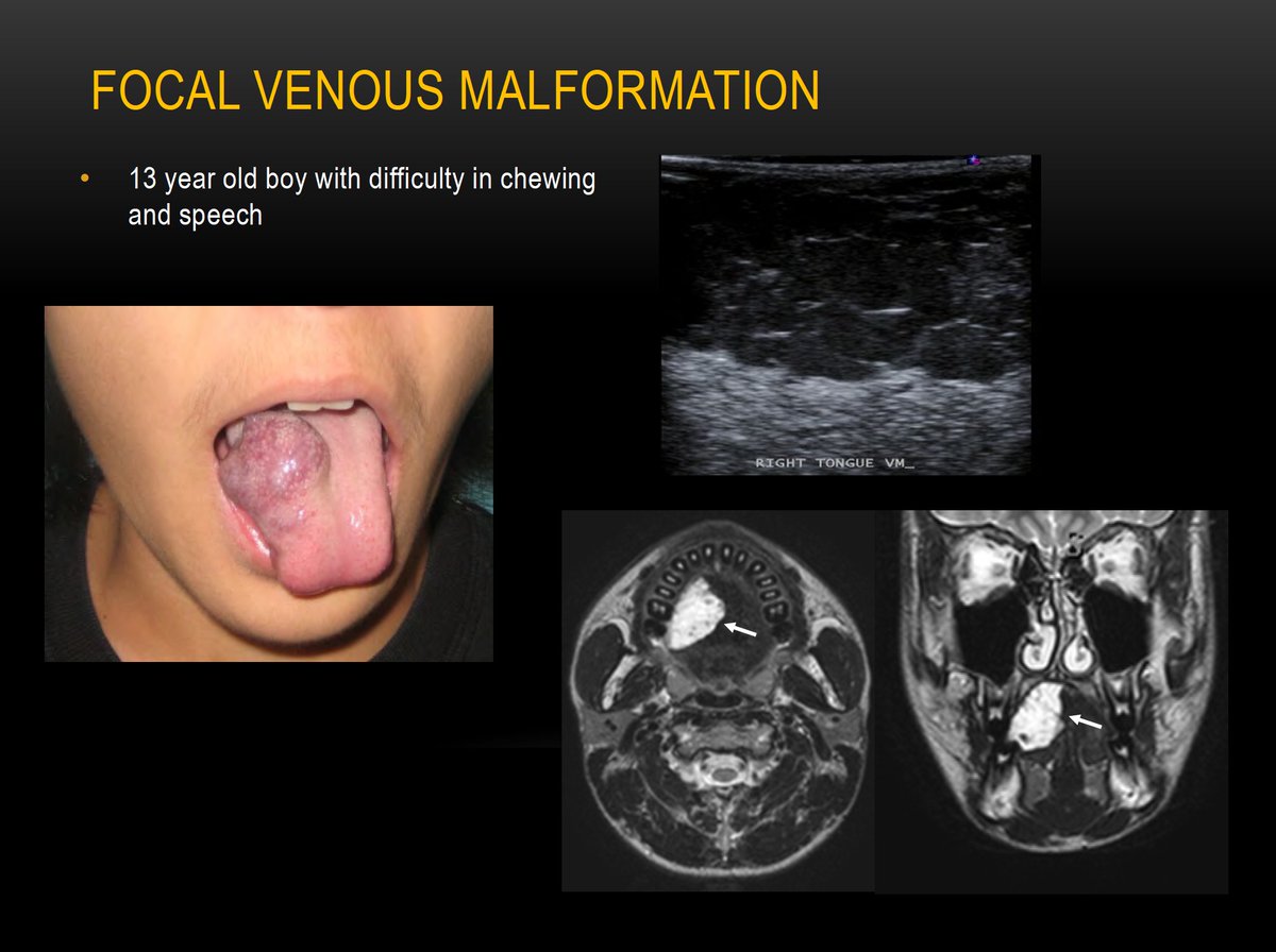 The_ASPNR's tweet photo. #ASPNR22: Session 7 Pediatric Vascular
Happening now, Dr. Sheena Pimpalwar (@SheenaPimpalwar) of UT Southwestern (@UTSW_Radiology) wowing us with her amazing expertise in Treatment of Vascular Anomalies in Children!  Remember, it takes a multi-disciplinary team! - DM https://t.co/wg7qnXBEyH