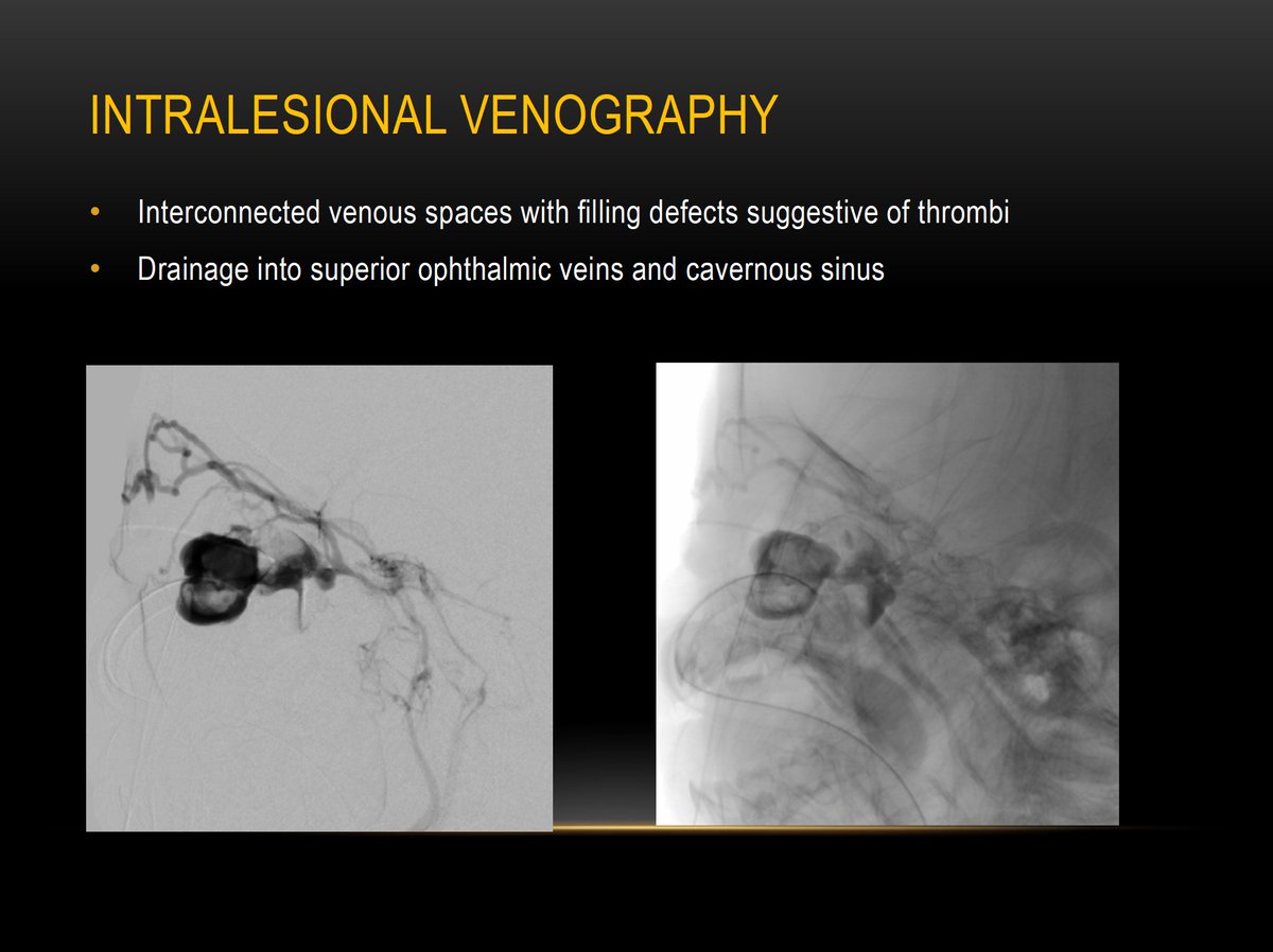 The_ASPNR's tweet photo. #ASPNR22: Session 7 Pediatric Vascular
Happening now, Dr. Sheena Pimpalwar (@SheenaPimpalwar) of UT Southwestern (@UTSW_Radiology) wowing us with her amazing expertise in Treatment of Vascular Anomalies in Children!  Remember, it takes a multi-disciplinary team! - DM https://t.co/wg7qnXBEyH