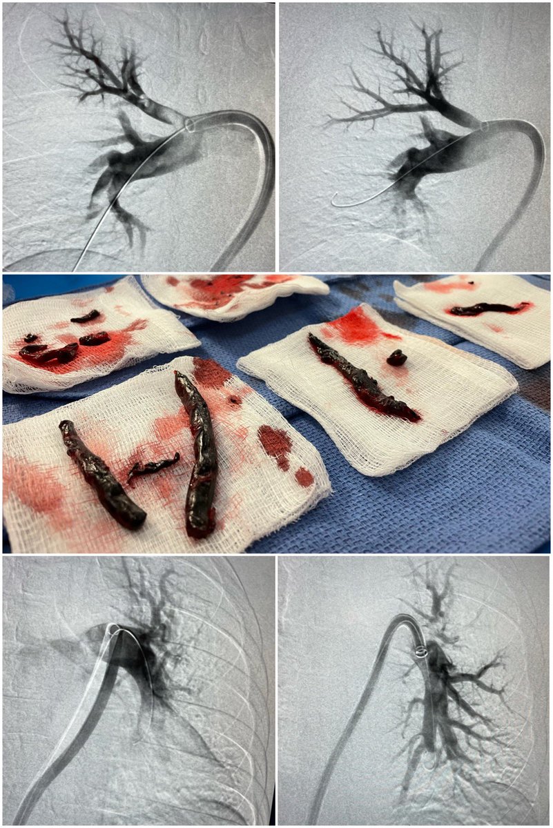 #DuneMovie is about worms. <a href="/InariMedical/">Inari, now part of Stryker</a> is about other worms. Submassive PE treated with immediate relief after left side cleared. Pressure drop 30 to 16! <a href="/SIRspecialists/">Society of Interventional Radiology</a> <a href="/SIRRFS/">SIR RFS</a> <a href="/SIR_ECS/">SIR ECS</a> #irad #cardiotwitter #vascular