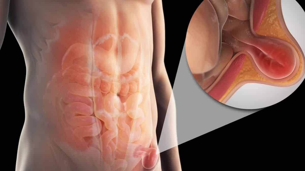 Lokalna infiltrativna anestezija kod operacija kila dlvr.it/SGn371