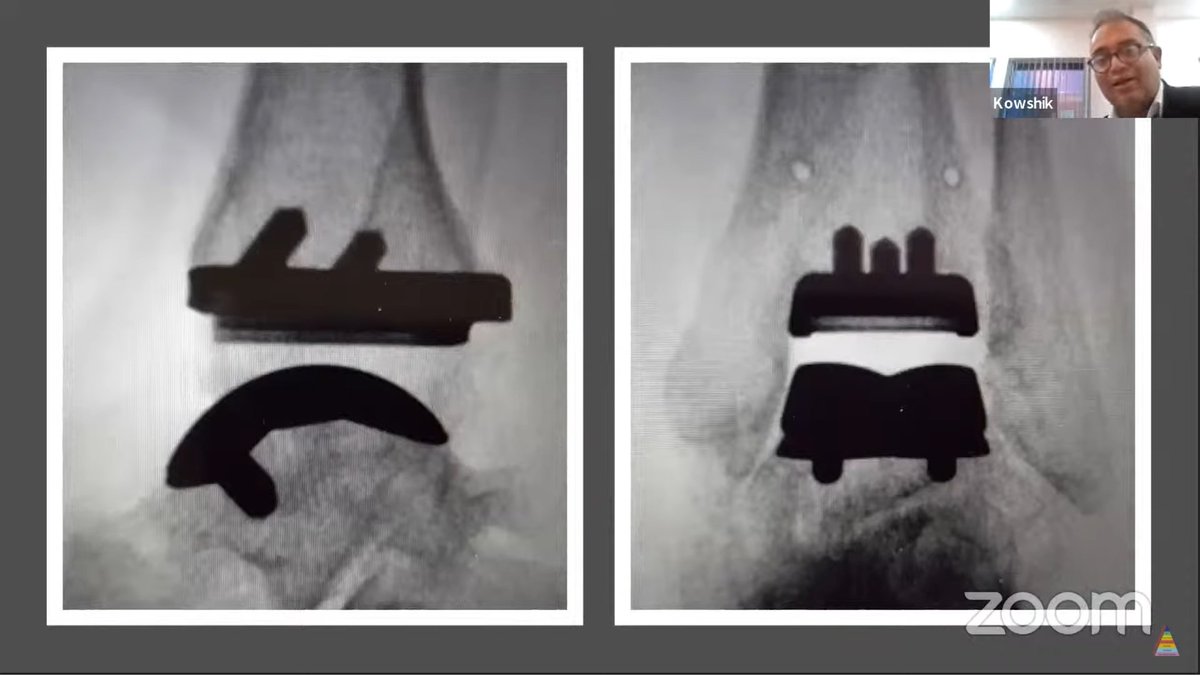 drhiteshg's tweet photo. https://t.co/EWzea2E5j8

Total Ankle Replacement #orthotwitter #orthopaedicprinciples #ankle #arthroplasty 
@AdvancedFAAssoc @MUSC_FA @idahofootdoc @TeamAnkle @NMCFootandAnkle @AnkleInstitute @Austinfoot @tonyabbottfoot @ankledoc1 @BurlingtonFoot https://t.co/fJBADBE31r
