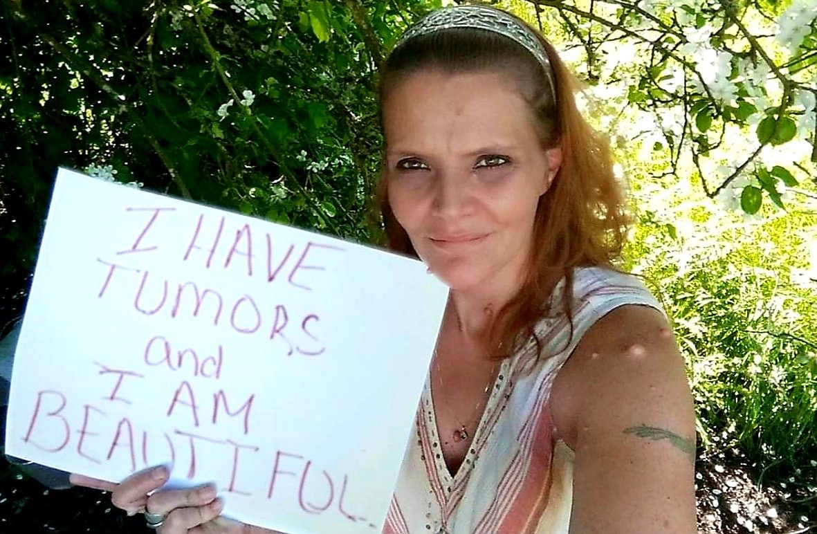 Anjeew's tweet photo. #MyDisabledLifeIsWorthy
Because I Love My Life &amp; I Love Myself! 
#Neurofibromatosis 

@nfnetwork @NFibromatosis @ChildrensTumor https://t.co/uVZ1Mpjc79