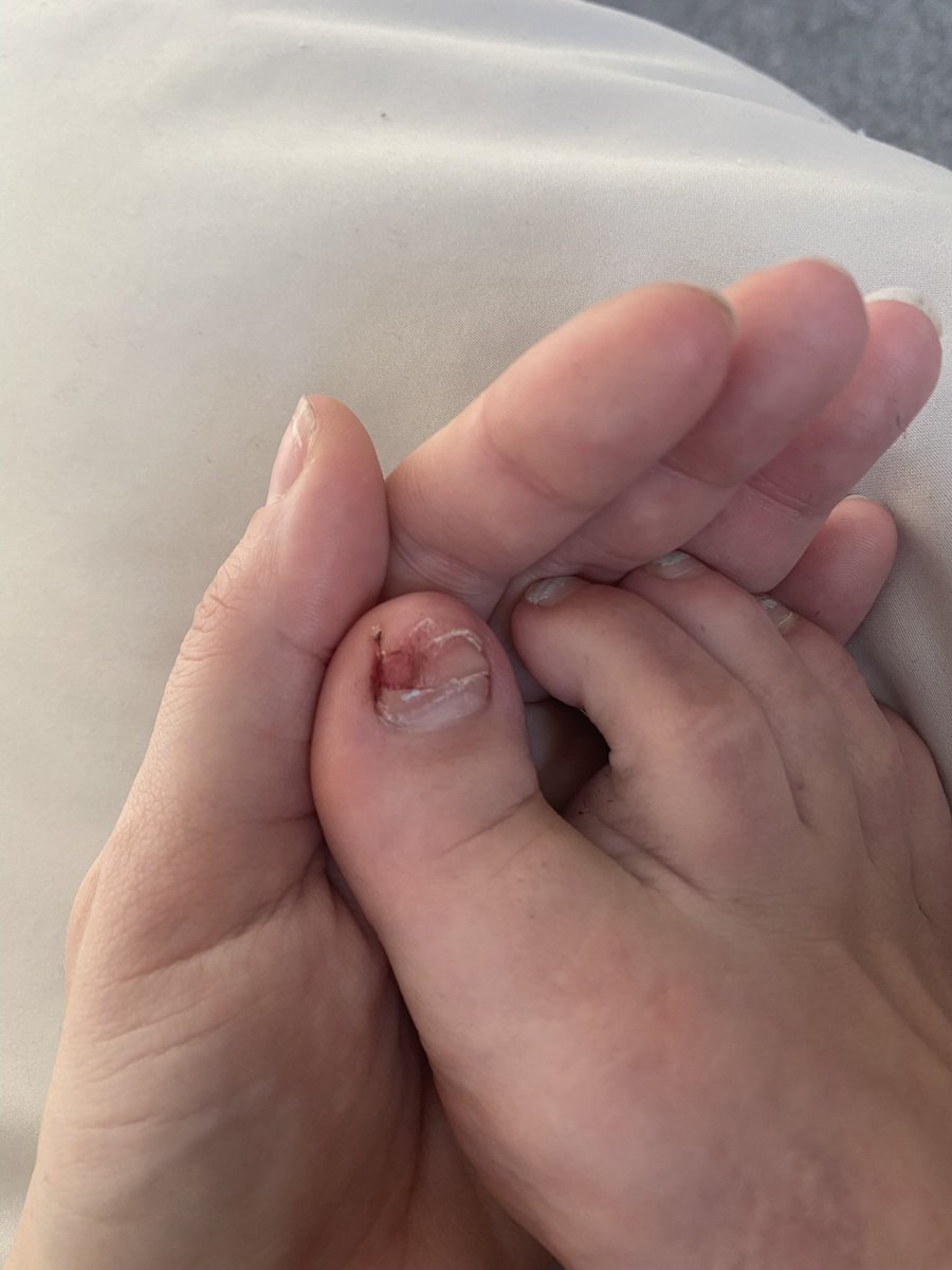 niccooley21's tweet photo. Exercise is supposed to be good for you right?!
Goodbye toenail π
#running #exercise #lossofbodyparts
@UKRunChat #itssupposedtobegoodforyou https://t.co/S1J3KQ5JnJ