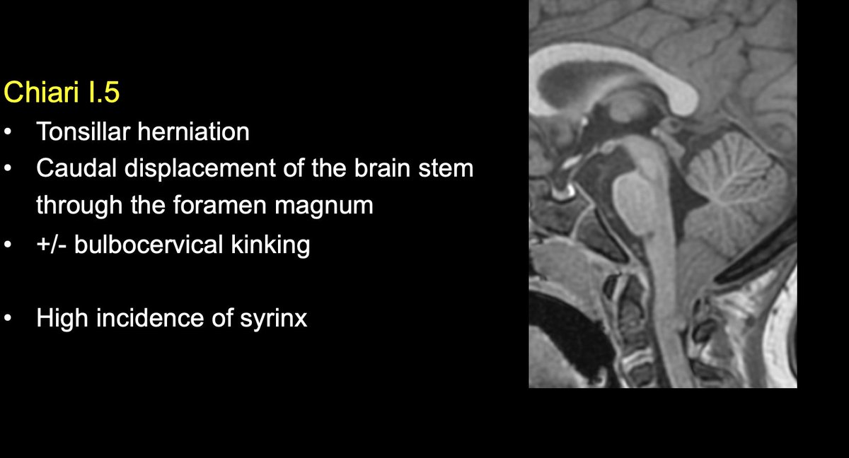 The_ASPNR's tweet photo. #ASPNR22 The craniocervical junction anatomy and the Chiari I + types made easy by Dr Gilbert Vézina from @ChildrensNatl. https://t.co/9Ipn1cBUV2