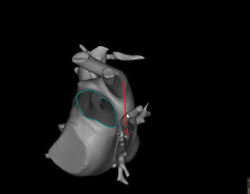 syamkumarmd's tweet photo. One of the weirdest anatomy I have seen #EPeeps @Cardiotwitter
@EPeeps_Bot @Ghassanj89 @SignalstEPh @MonaghanJenieca https://t.co/NFGnZea4w8