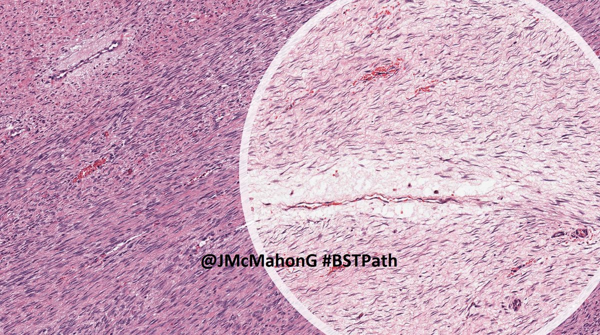 "As if an elephant stomped on them"

Desmoid-type fibromatosis has, IMO, the flattest cells in #BSTPath 

I teach DTF cells are so flat as if an elephant stomped on them!

Notice the perivascular edema. Aberrant nuclear localization B-catenin in many; however, trust H&amp;E for dx