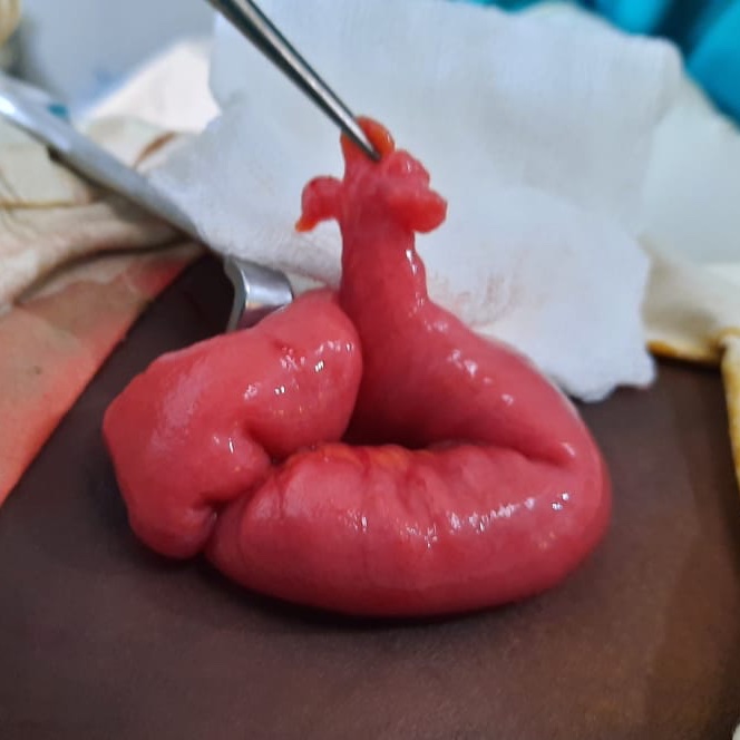 GodahewaSupun's tweet photo. "Frequently suspected , often looked for and seldom found" - Charles Mayo  #GITwitter  #MedEd  @KelaniyaS  @ScottRSteeleMD  @SAGES_Updates  Views of prophylactic removal if found incidentally  WWYD https://t.co/1NusIQCqzv