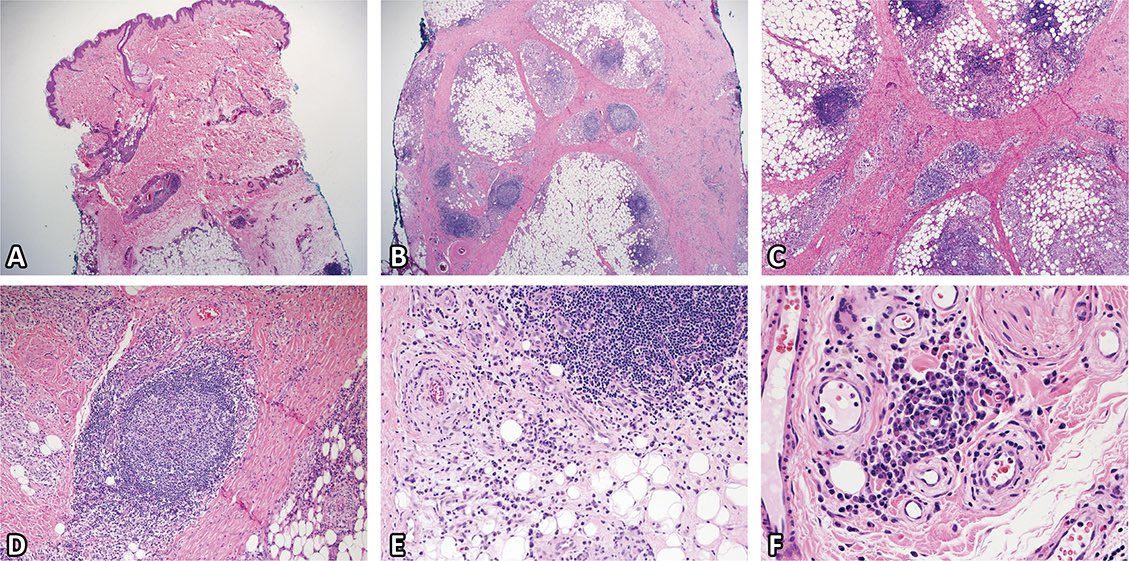 VHNguyenMD's tweet photo. Sunday Reading 📖
(#ReadItForYou like @Cristina_VargAP ☺️)

Am J Dermatopathol 2019;41:67 - @alegru18 

16yo thigh mass
Initially dx as pseudolymphoma
#dermpath #pedipath #tweetorial

@grenierkarlMD @KevinCoteMD @LeducValerie1 https://t.co/1zVchzSaam
