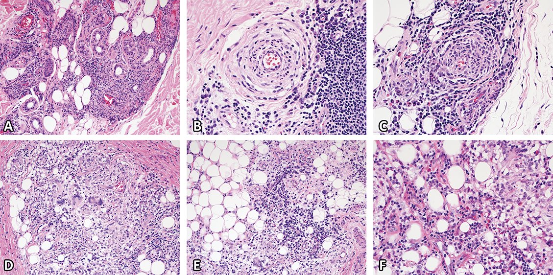 VHNguyenMD's tweet photo. Sunday Reading 📖
(#ReadItForYou like @Cristina_VargAP ☺️)

Am J Dermatopathol 2019;41:67 - @alegru18 

16yo thigh mass
Initially dx as pseudolymphoma
#dermpath #pedipath #tweetorial

@grenierkarlMD @KevinCoteMD @LeducValerie1 https://t.co/1zVchzSaam