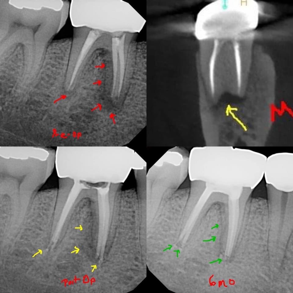 DrRicoShort's tweet photo. A new study in JOE shows no difference in success between 1 visit and 2 visit retrx endodontics in the presence of on apical lesion.
#DrRicoShort #dentist #retreatment #Onevisit #TwoVisit #Endodontics #celebrityendodontist
#therootcanalspecialisttothestars
Dr. Rico Short https://t.co/4jEvZQZWjM