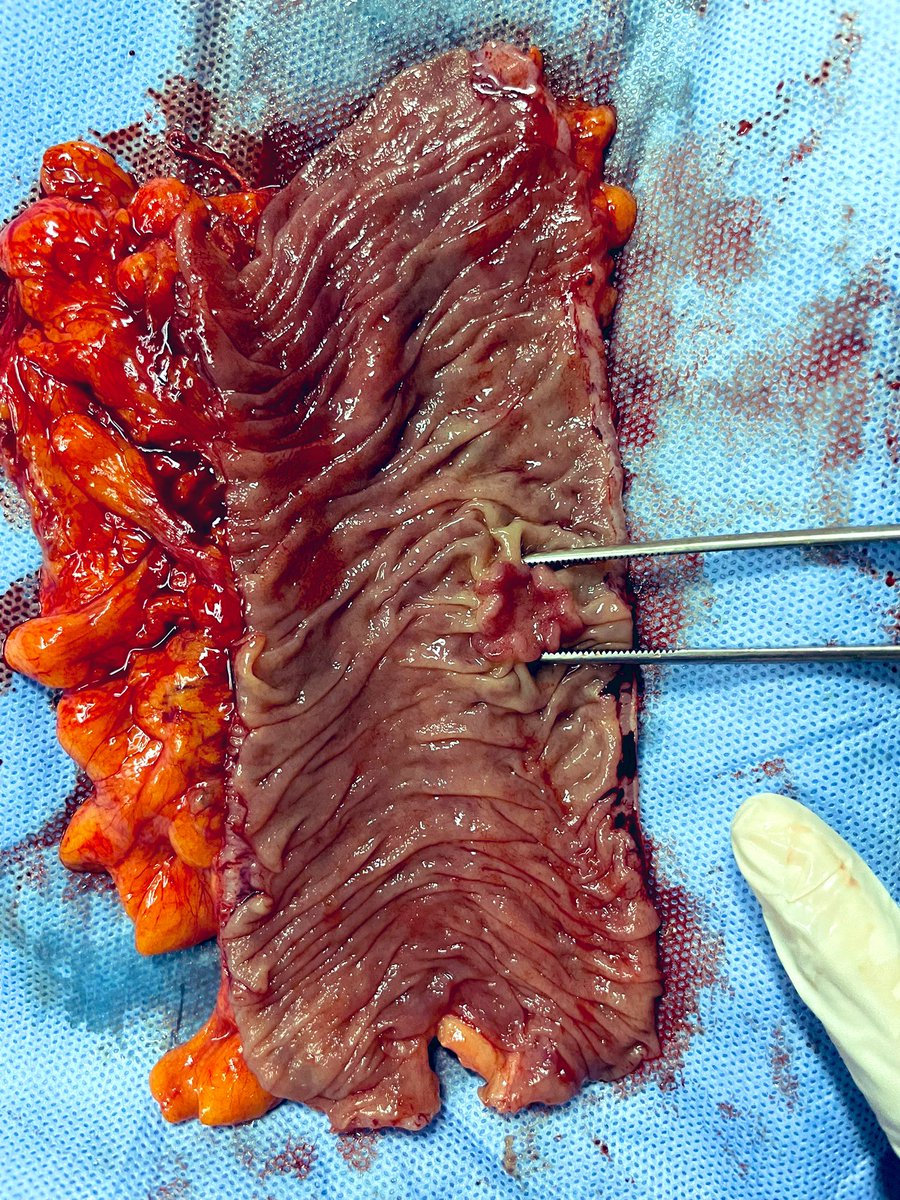 ELWissam's tweet photo. A picture of an early colon cancer in a patient who underwent resection. #colon #cancer #surgery #prevention #CancerAwareness #Survivor https://t.co/jGQsczZ2vW
