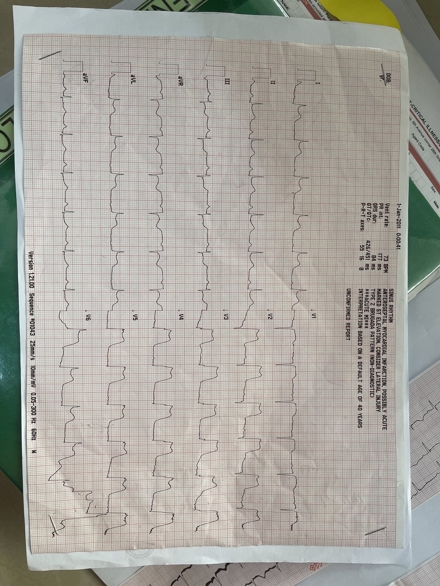 Codebleu4's tweet photo. Este… ST elevation 😟
Good morning ☀️
#Cardiacunit #intensivecareunit https://t.co/UUs26pizO1