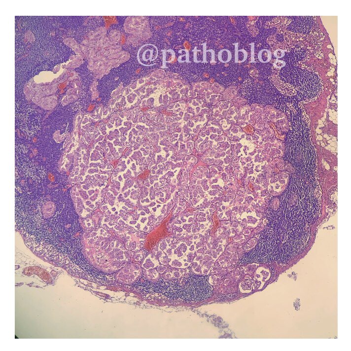 pathoblog's tweet photo. Metastasis of papillary thyroid carcinoma in lymph node. #pathoblog #PathTwitter #thyroid #endocrine #endopath #pathology https://t.co/YtMP4DgFL3
