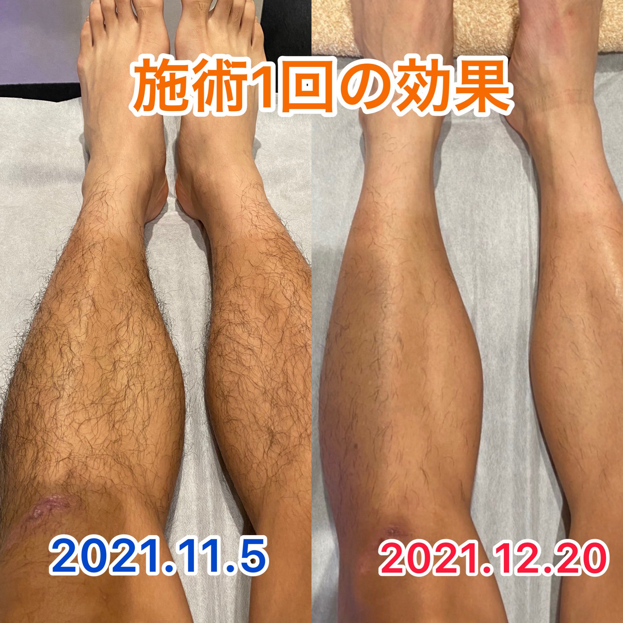 脱毛サロン Bmore ビモア Bmore Twitter