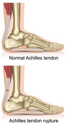 KinectMD's tweet image. #KlayThompson scored 17 points in his return after missing 941 days. He hadn’t played since tearing his left ACL in Game 6 of the 2019 NBA finals against Toronto. Additionally, he tore his right Achilles tendon in November 2020.  #KinectMD #SportsMedicine