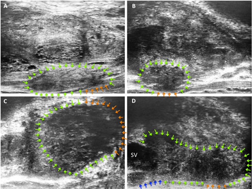 ExactImaging's tweet photo. Congratulations to Dr. Vittorio Fasulo @NBuffi @GLughezzani and the whole team at @HumanitasMilano Research Hospital on your publication in World Journal of Urology. Using #MicroUS to predict Extraprostatic extension of Prostate Cancer
https://t.co/qovoeMJt5Q
@ExactImaging https://t.co/SDyQZOOHlS