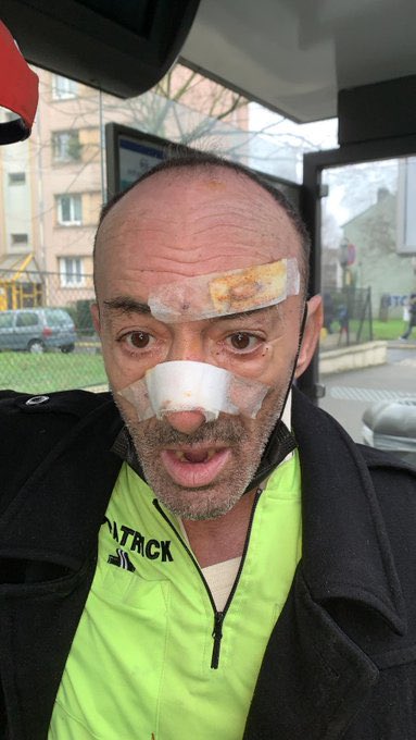 La victime de ces voyous s’appelle Ali, il est SDF et voici une photo de lui après cette agression lâche.