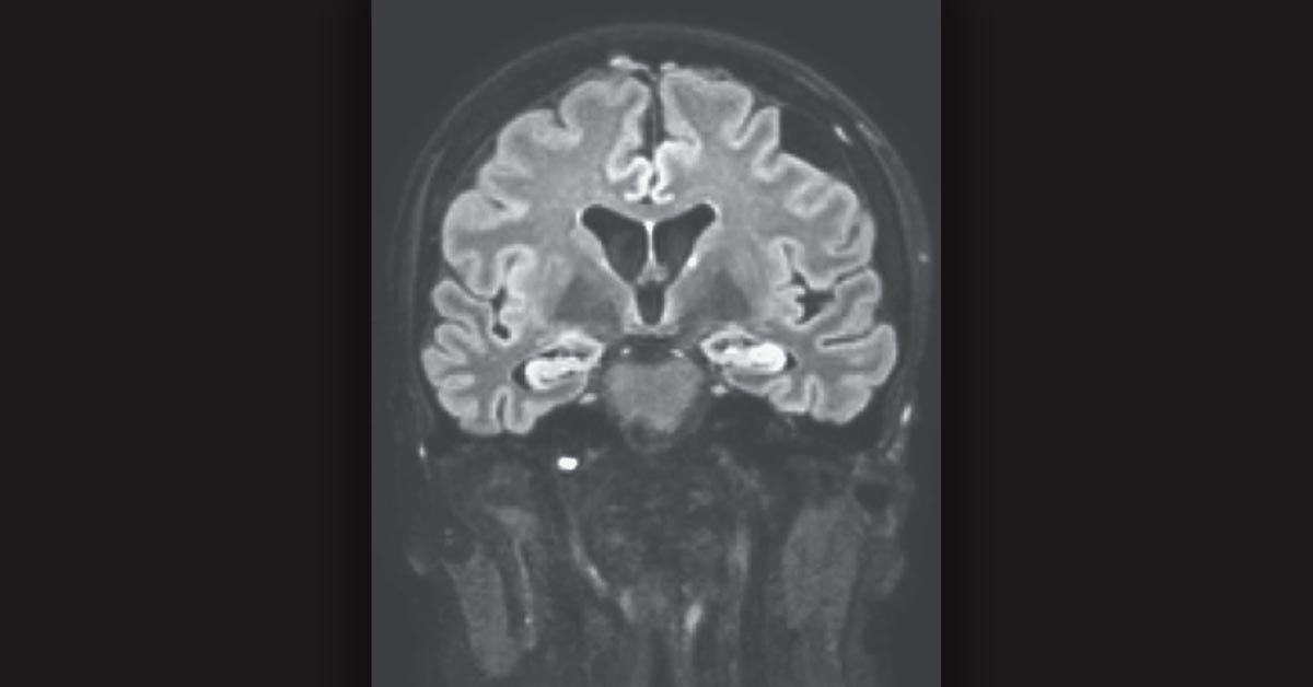 NEJM's tweet image. Confusion developed in a 49-year-old woman with relapsed diffuse large B-cell lymphoma within days after she received CAR-T therapy. She had difficulty putting words together and was disoriented, but no focal abnormalities were noted. nej.md/32Se5Kg