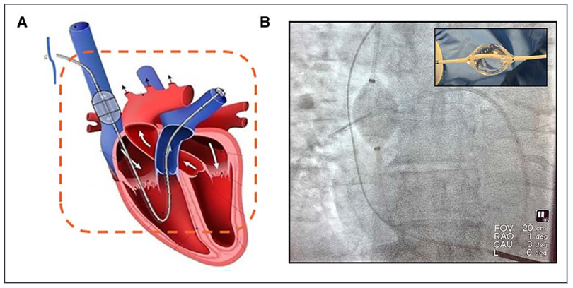 DrSethdb's tweet photo. Congratulations @NavinKapur4 and colleagues for the publication of VENUS-HF evaluating novel approach to ADHF using intermittent SVC occlusion with the preCARDIA device
https://t.co/qN7RoaZBF3 https://t.co/V63YEtos8Y