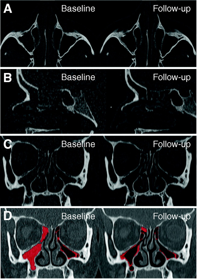 AnnalsATS's tweet photo. Impact of Cystic Fibrosis Transmembrane Conductance Regulator Therapy on Chronic Rhinosinusitis and Health Status: Deep Learning CT Analysis and Patient-reported Outcomes

🔓 Open Access
🔗 https://t.co/y8myEnh5C8 https://t.co/zBz9wlRCwU