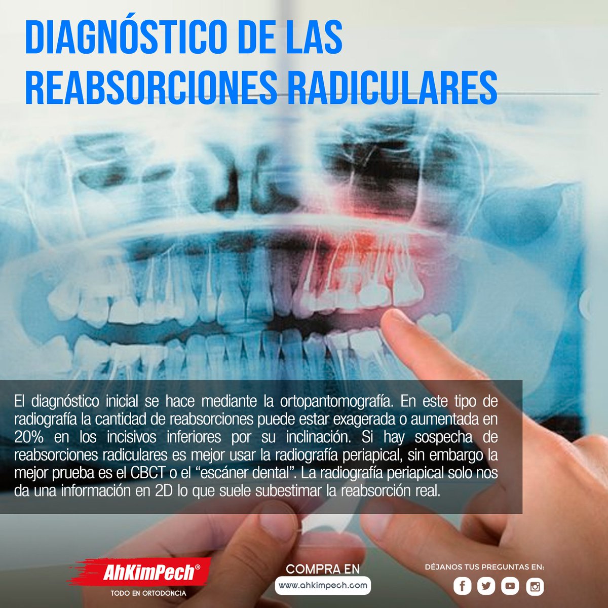 AhKimPechMX's tweet photo. Una radiografía periapical forma parte de las denominadas radiografías intraorales, con el fin de obtener imágenes completas de los dientes y estudiarlos en su totalidad: ápice, corona, raíz, tejido óseo y espacio periodontal. #radiografia #periapical #ortodoncista #odontologo https://t.co/DMVMLxpS4f
