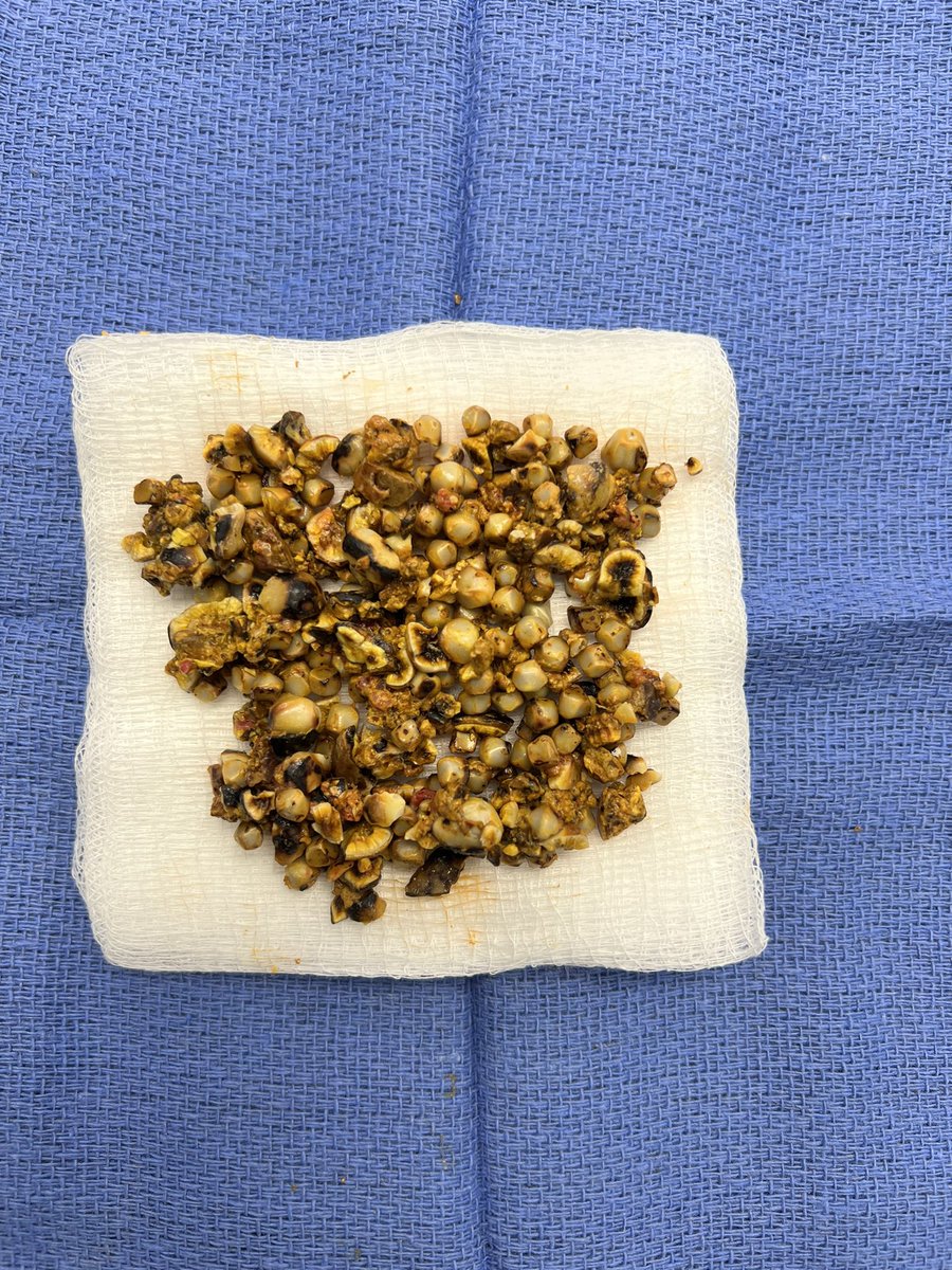 Non-surgical #gallstone removal. #Stones for days. Laser, basket, flushing, 24 Fr sheath. My assist was a stone expert by the end of the case. #stoneremoval #gallbladder #surgery #irad #gastroenterology @bostonsci