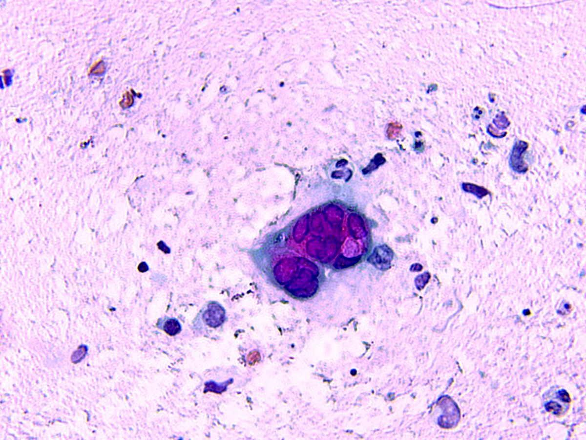 15 años . Panadizo herpetico .  Tzanck típico :queratinocito multinucleado con molding nuclear y marginación de cromatina