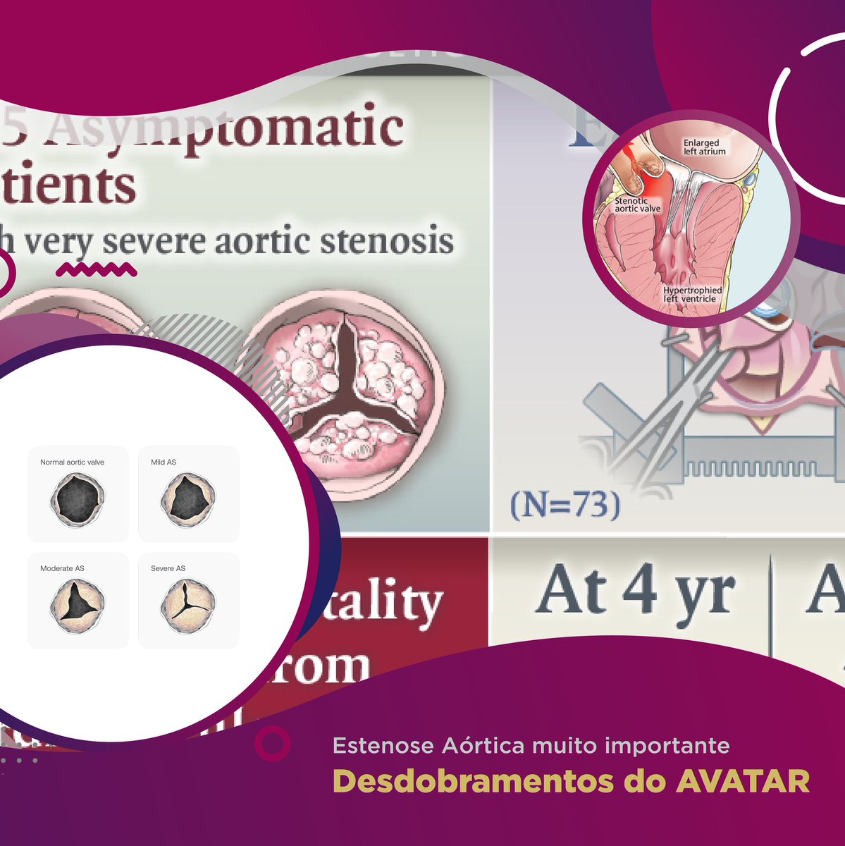 Very important Aortic Stenosis is a recent discussion in cardiology, as a subgroup that deserves a differentiated approach within Aortic Stenosis.
.
Apparently, an early approach might be interesting, but do you know when?
.
Go to thevalveclub.com.br