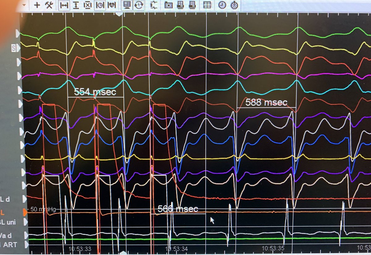 #ablateVT can really kick your teeth in but then you see this kind of thing and you come back for more #EPeeps