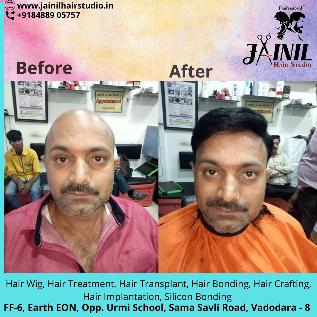 Hair Replacement Service in Hyderabad Non Surgical Hair Replacement