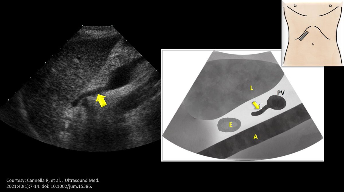 NephroP's tweet image. #POCUS quiz:
What is the structure indicated by arrow?
Corresponding illustration as well as scan position shown.
#Anatomy exercise for #VExUS enthusiasts. #MedEd
Poll in thread 👇
(L = liver, PV = portal vein, E = esophagus, A = aorta)