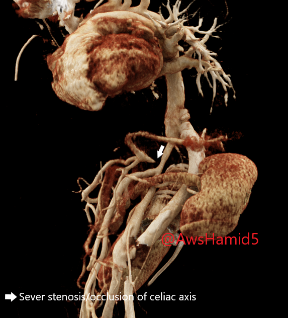 AwsHamid5's tweet photo. Case #27: Neurofibromatosis (NF1) of the aorta and small vessels. NF affects abdominal aorta and small vessels resulting in a long segment of aortic coarctation and sever stenosis/occlusion celiac axis status post bypass graft. #radres #chestRadEd #FOAMed #FOAMrad @EmoryRadiology https://t.co/EuUFS6lw6P
