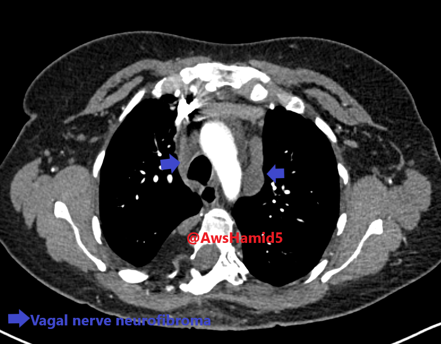 AwsHamid5's tweet photo. Case #27: Neurofibromatosis (NF1) of the aorta and small vessels. NF affects abdominal aorta and small vessels resulting in a long segment of aortic coarctation and sever stenosis/occlusion celiac axis status post bypass graft. #radres #chestRadEd #FOAMed #FOAMrad @EmoryRadiology https://t.co/EuUFS6lw6P