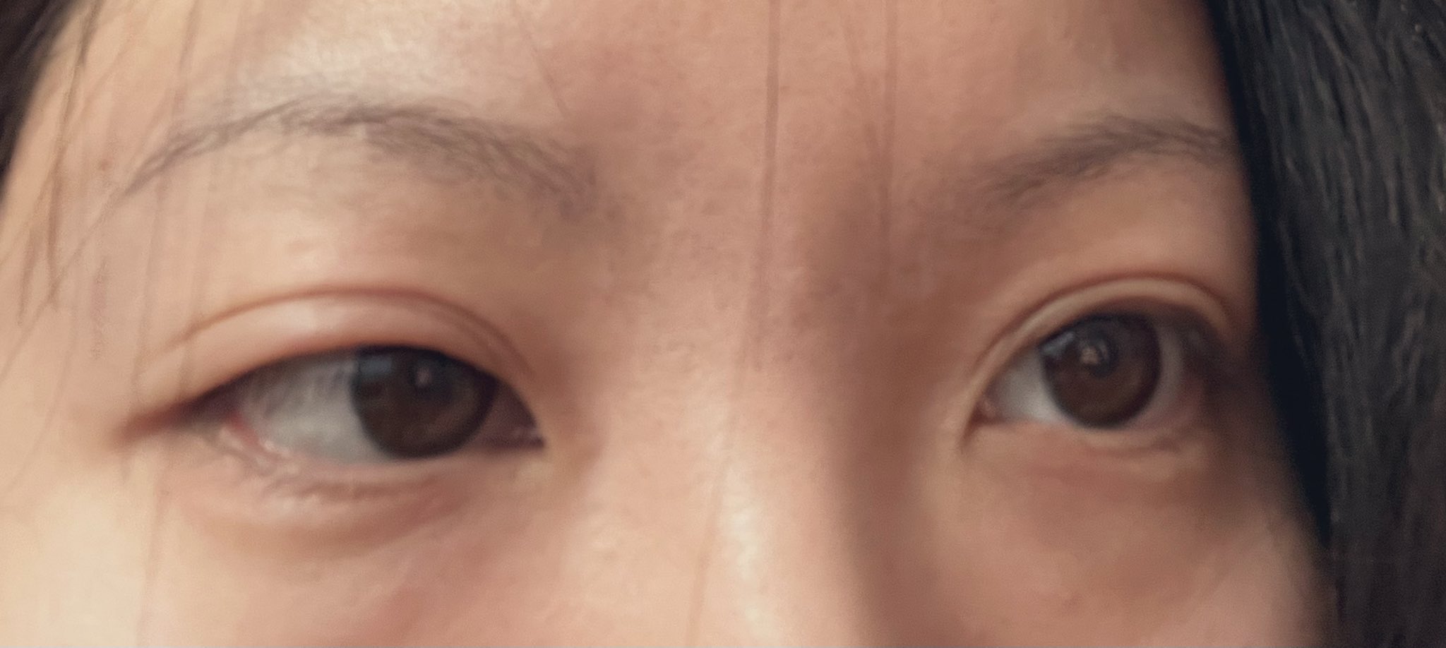 Swollen Eyelid Crying