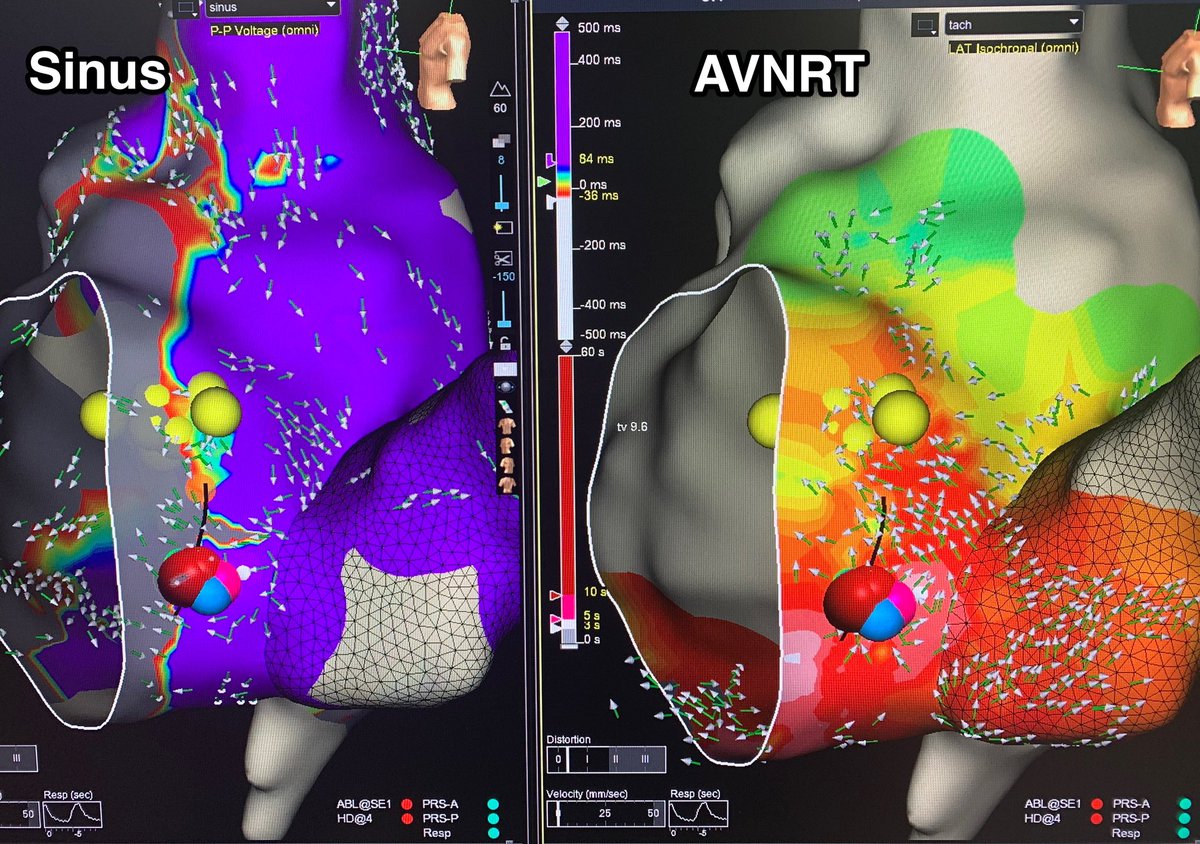 One of my 1st cases with @AbbottCardio’s new EnSite X system. Terrific fidelity and example if low voltage bridge in an atypical (fast/slow) AVNRT @USFCardiology