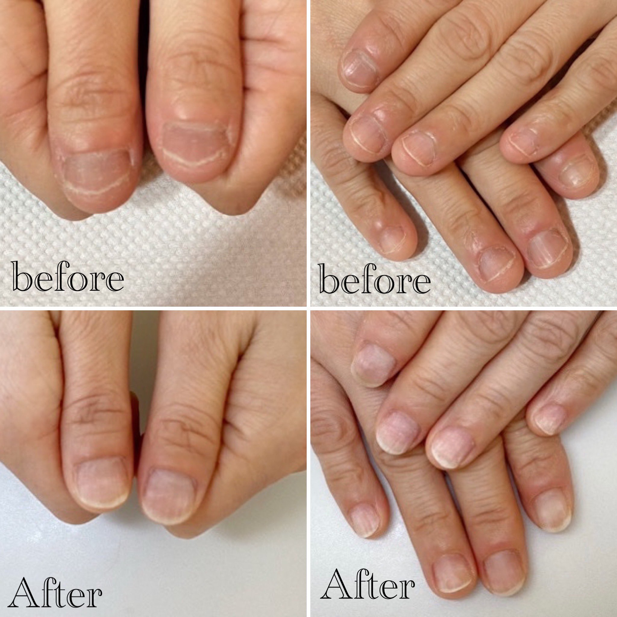 深爪矯正サロン ハンドとフット爪の長さだし 下北沢自爪育成ネイルサロン 2ヶ月でここまでのびました 深爪 長さだし 深爪矯正 長さだしサロン 爪育成 ネイルサロンアリューム 東京都世田谷区北沢3 11 グレース北沢1 ホームページ T