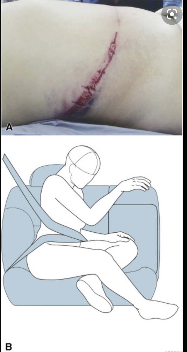 19joho's tweet photo. I am not anti seat-belt. I love seat belts and wear them often. 

I am however not a seat belt absolutist.  Seat belts can cause injuries and parents need to know there is no risk-free choice for their child. 

We need to approach this issue with honesty and nuance. https://t.co/uxgtHzcEpV