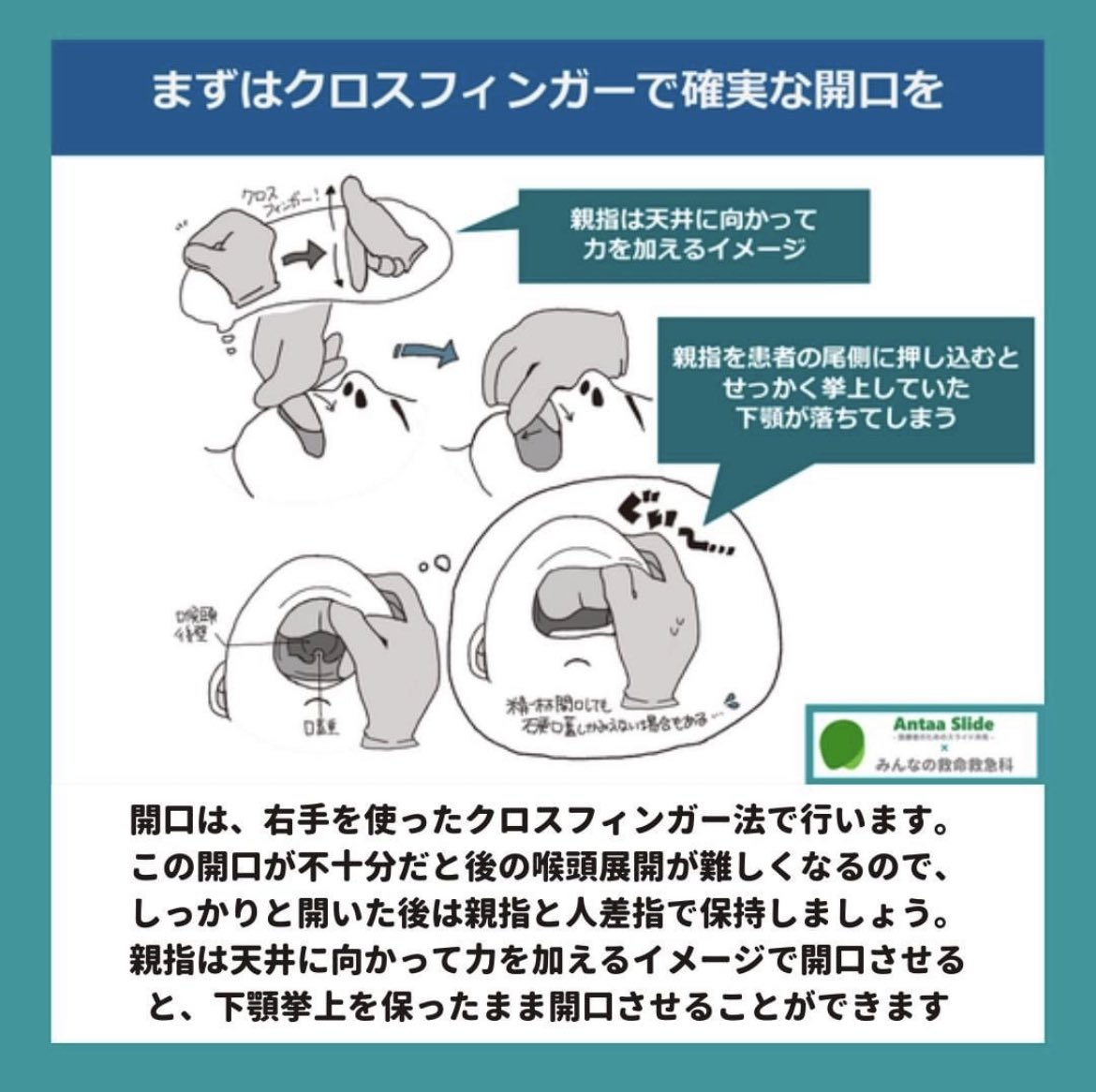 気管挿管の介助テキスト – Kazuki＠ナスコン, image size:1170x1166