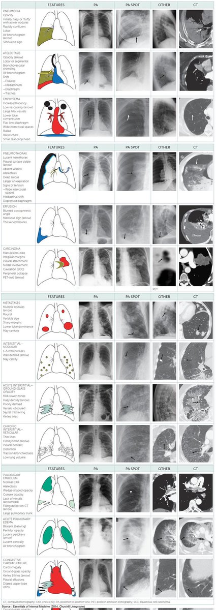 𝑪𝒐𝒎𝒑𝒊𝒍𝒆𝒅 Radiographic Presentations of Pulmonary Diseases. 

<a href="/grepmeded/">GrepMed</a> 

<a href="/ManualOMedicine/">Manual Of Medicine</a>