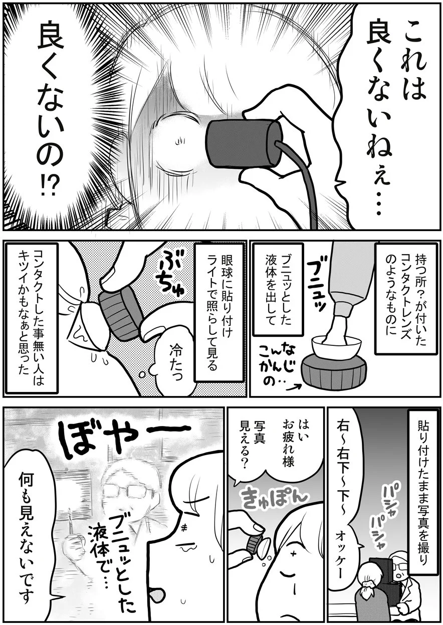 網膜剥離になったときの話！気になる症状がある方は早めに受診を！