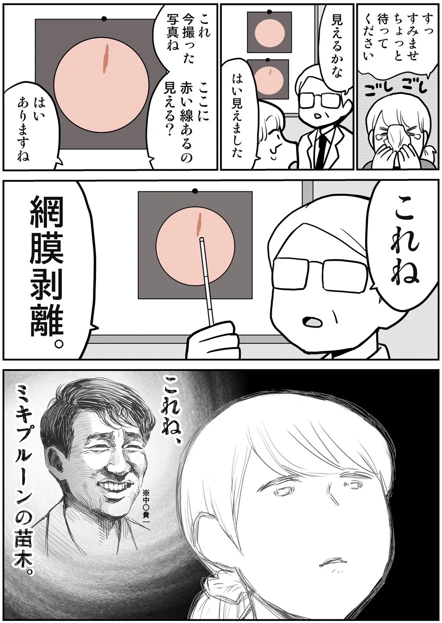 網膜剥離になったときの話！気になる症状がある方は早めに受診を！