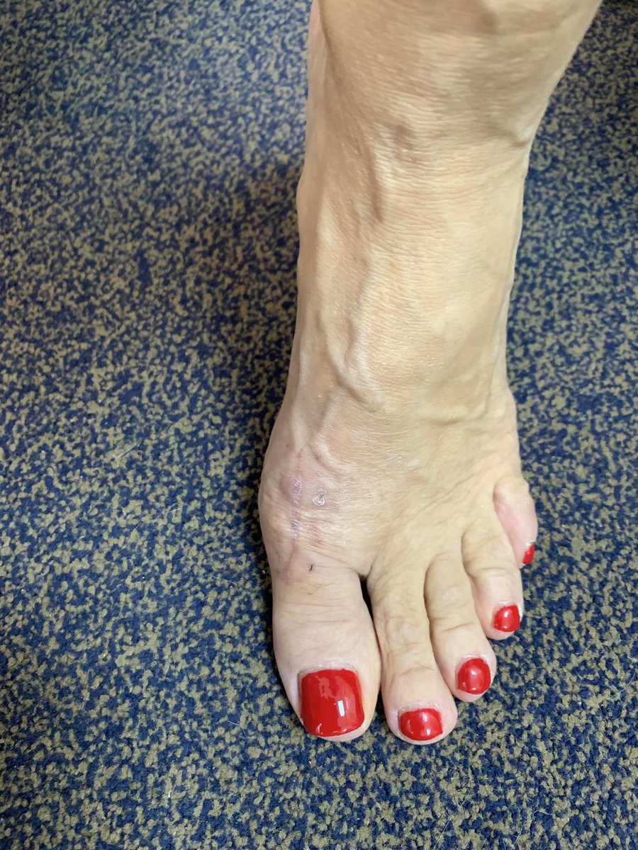 3 month after #Cartiva replacement. Functional movement restored. #Pain free movement of the big toe joint. #foot #surgery #replacement
