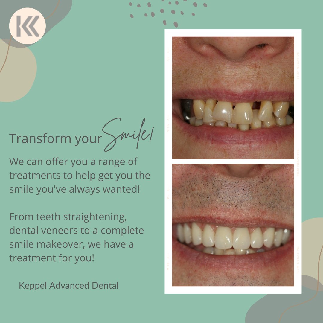 KeppelDentistry's tweet photo. We offer Free Consultations
#cosmeticdentistry #smilemakeover https://t.co/Og72W6oX0H